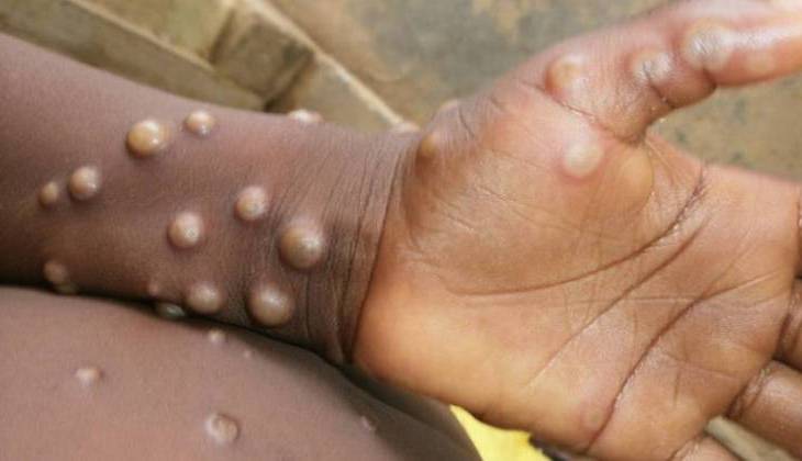 Varíola dos macacos: 95% dos casos são do sexo masculino